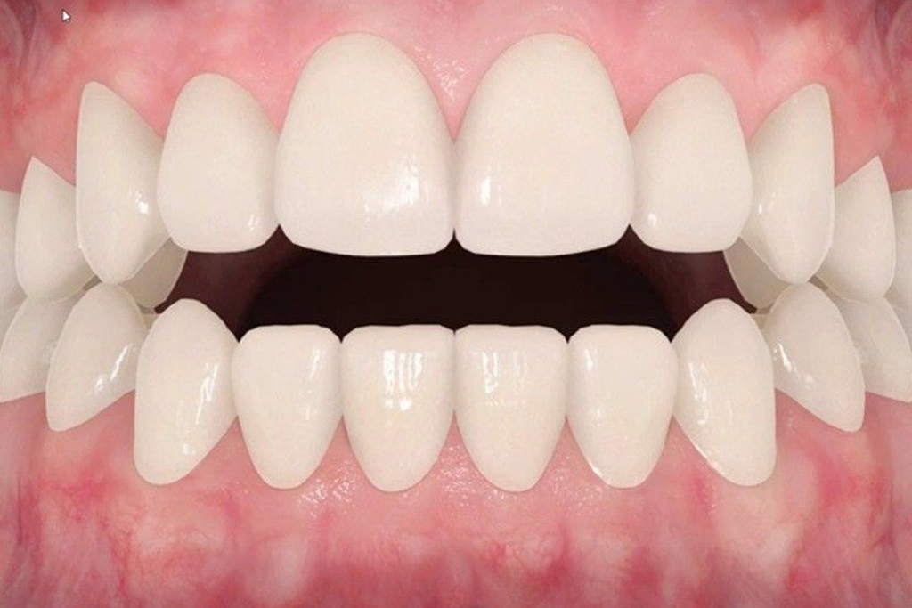 Allograft