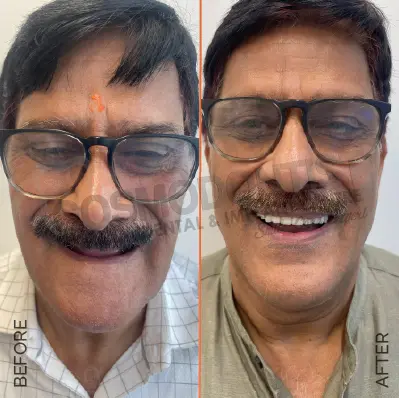 Before and after dental treatment result 11 at Cosmodontist Clinic