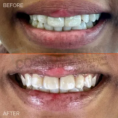 Before and after dental treatment result 12 at Cosmodontist Clinic