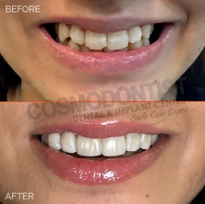 Before and after dental treatment result 13 at Cosmodontist Clinic