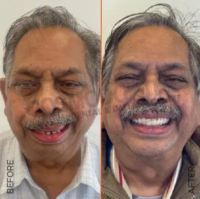 Before and after dental treatment result 3 at Cosmodontist Clinic