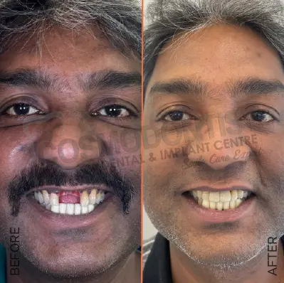 Before and after dental treatment result 4 at Cosmodontist Clinic