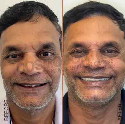 Before and after dental treatment result 5 at Cosmodontist Clinic