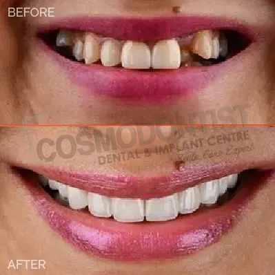 Before and after dental treatment result 7 at Cosmodontist Clinic
