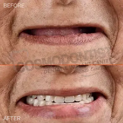 Before and after dental treatment result 8 at Cosmodontist Clinic