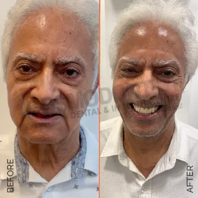 Before and after dental treatment result 9 at Cosmodontist Clinic