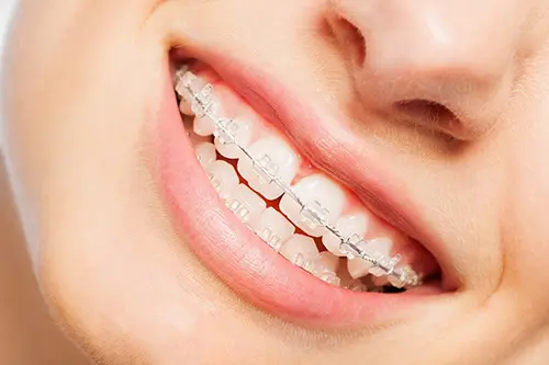 Ceramic Conventional Brace