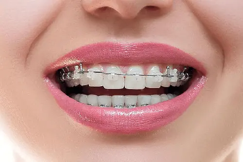 Metal Conventional Braces