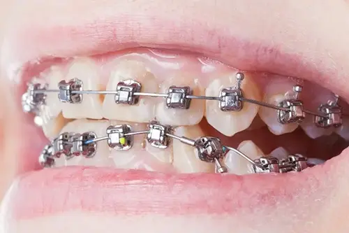 Metal Self Ligating Braces