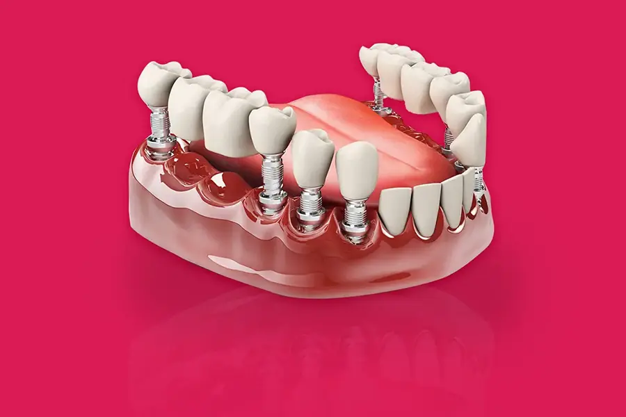 Dental Crown & Bridges Treatment