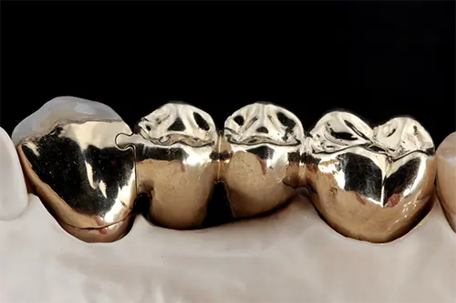 Metals crowns