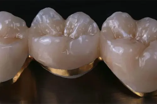 Porcelain-fused-to-metal crowns