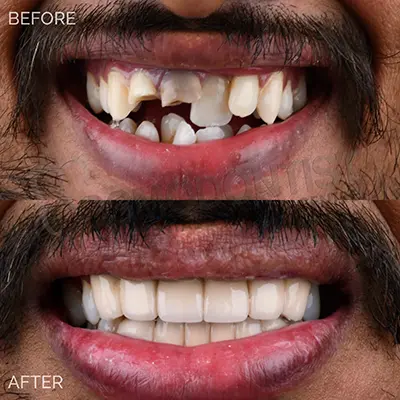 Dental Implants