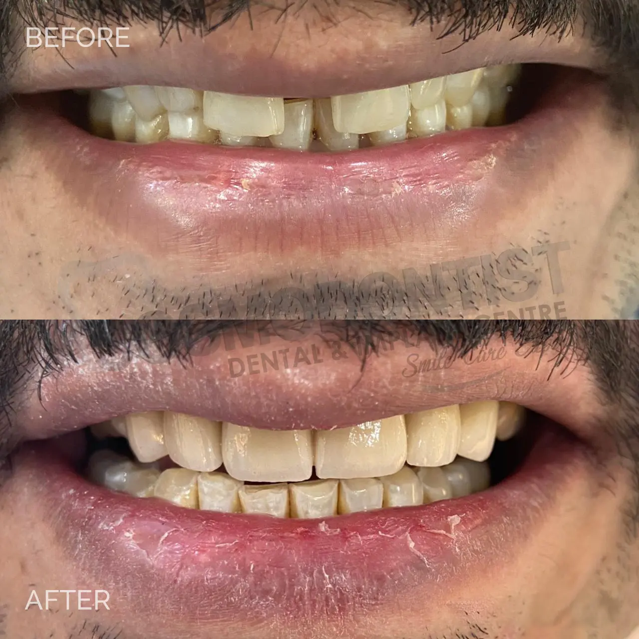 Dental Implants
