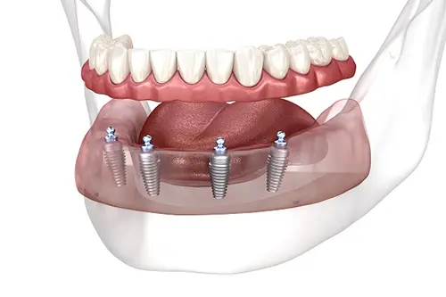 All-on-4 Dental Implants