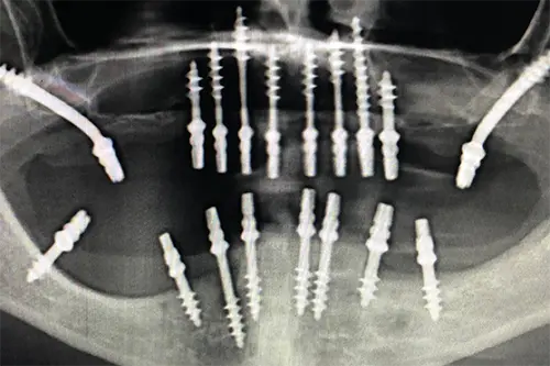 Basal Implants (IHDE Implants System)