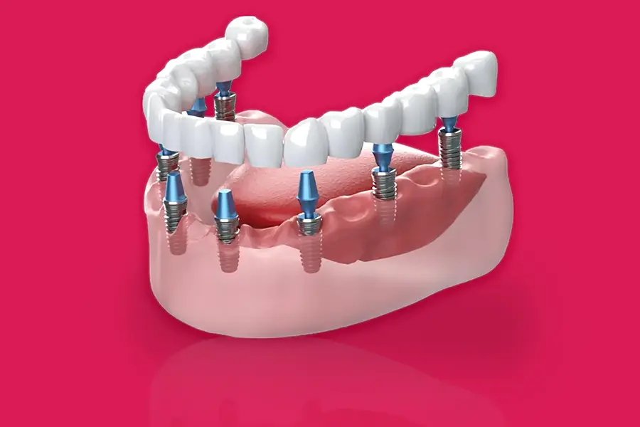 Dental Implants in Gurgaon, India