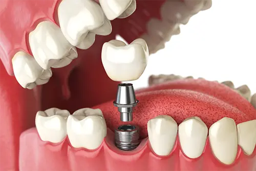 Single Tooth Implant