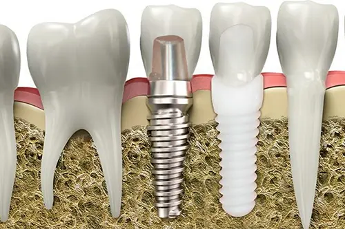 Zirconia Implants (Ceramic Implants)