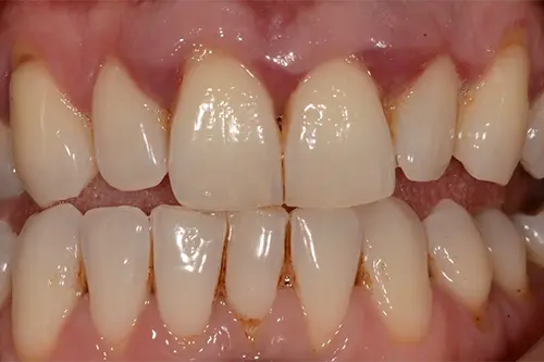 ADVANCED PERIODONTITIS