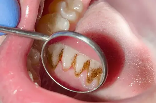 GINGIVITIS