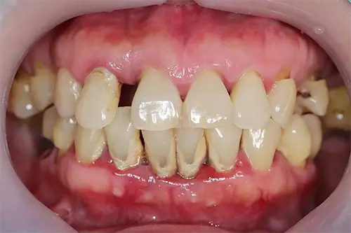 PERIODONTITISns