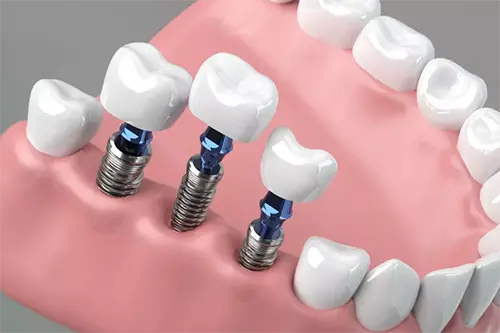 Artificial tooth placement