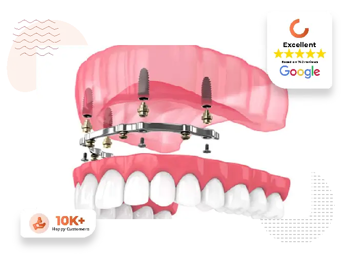 implant retained denture