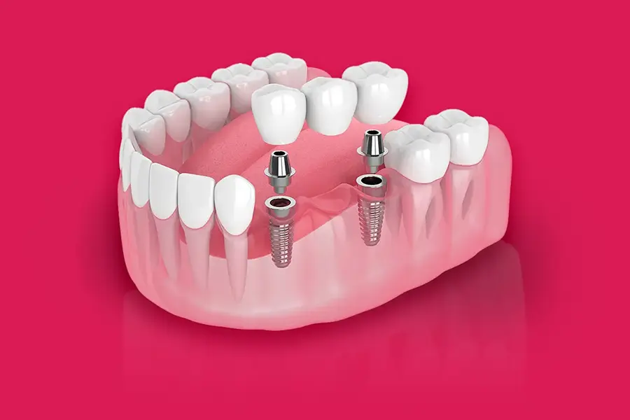Implant-Supported Bridges