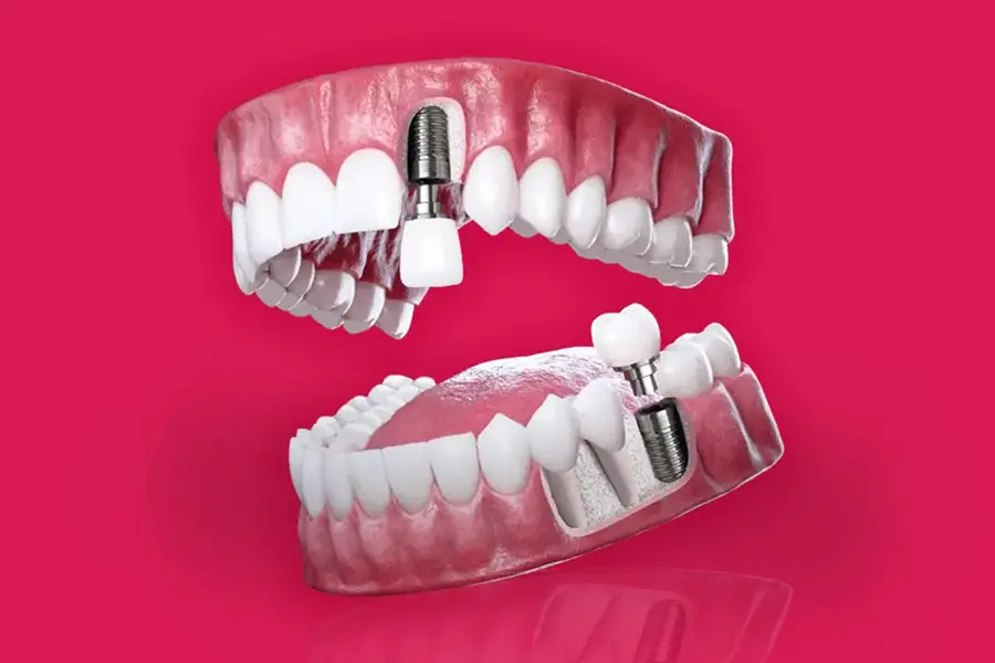 Single Tooth Dental Implants