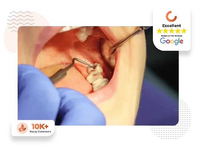 Wisdom tooth surgical extraction illustration
